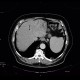 Cholangiocellular carcinoma of liver, dilation of intrahepatic ducts: CT - Computed tomography